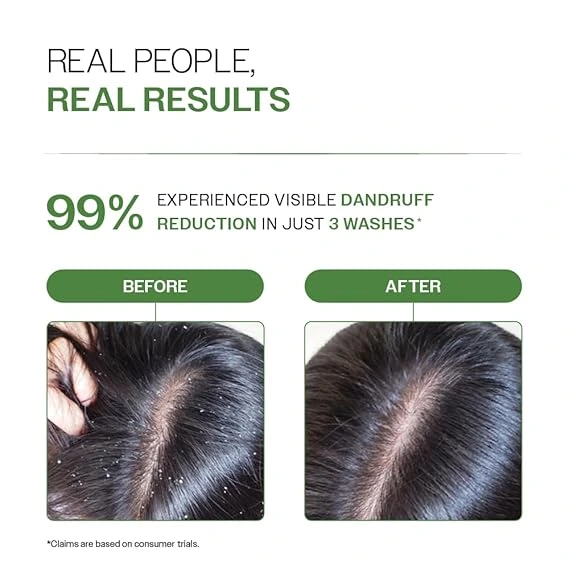 anti dandruff shampoo